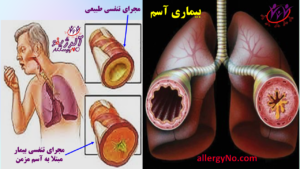 بیماری آسم- 2- آلرژینو