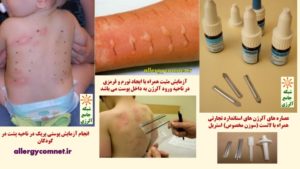 آزمایش یا تست پوستی برای تشخیص آلرژی ۲- شبکه جامع آلرژی