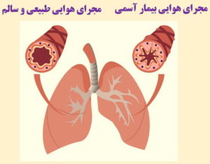 آسم ورزشکاران-برونش ها