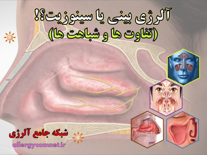 آلرژی-بینی-رینیت-آلرژیک-یا-سینوزیت-آلرژینو