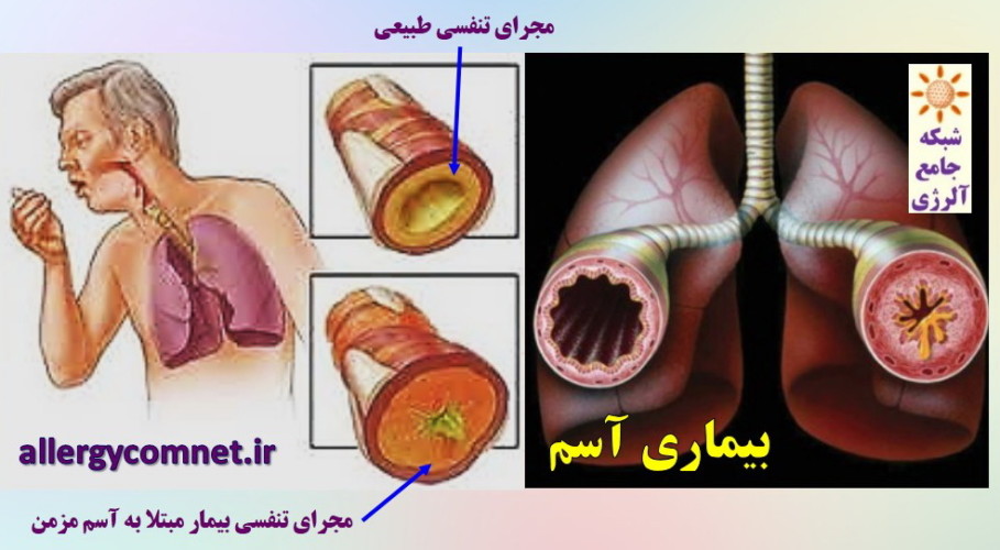 بیماری آسم- شبکه جامع آلرژی