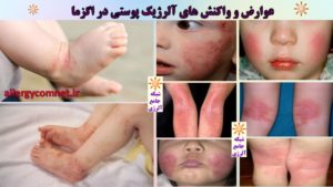 بیماری پوستی اگزما در کودکان و بزرگسالان ۱- شبکه جامع آلرژی