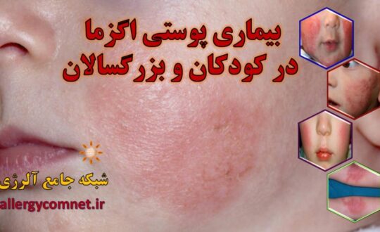 بیماری-پوستی-اگزما-در-کودکان-و-بزرگسالان-شبکه-جامع-آلرژی