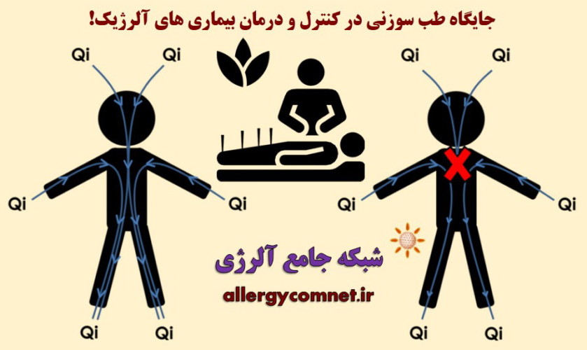 جایگاه طب سوزنی در کنترل و درمان بیماری های آلرژیک ۲- شبکه جامع آلرژی-