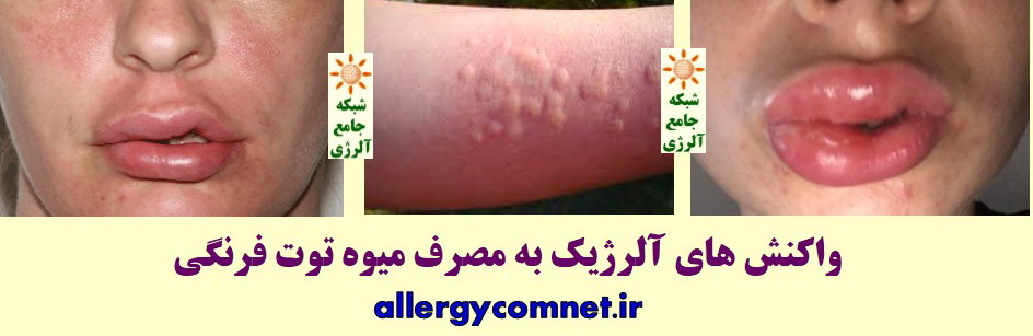 حساسیت یا آلرژی به میوه توت فرنگی ۲- شبکه جامع آلرژی
