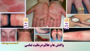 درماتیت تماسی ۱- شبکه جامع آلرژی