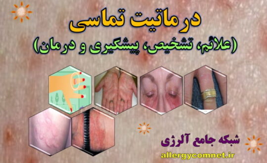 درماتیت-تماسی-علائم،-تشخیص،-پیشگیری-و-درمان-شبکه-جامع-آلرژی
