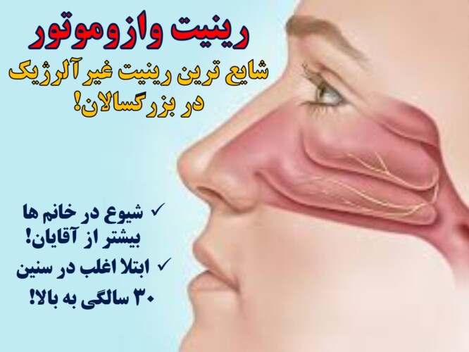 رینیت وازوموتور- گرفتگی و آبریزش بینی شایع در بالغین ۱- شبکه جامع آلرژی