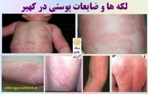 لکه ها و ضایعات پوستی در کهیر- شبکه جامع آلرژی