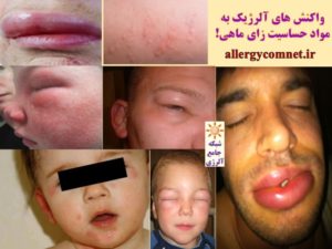 واکنش های آلرژیک به ماهی-شبکه جامع آلرژی