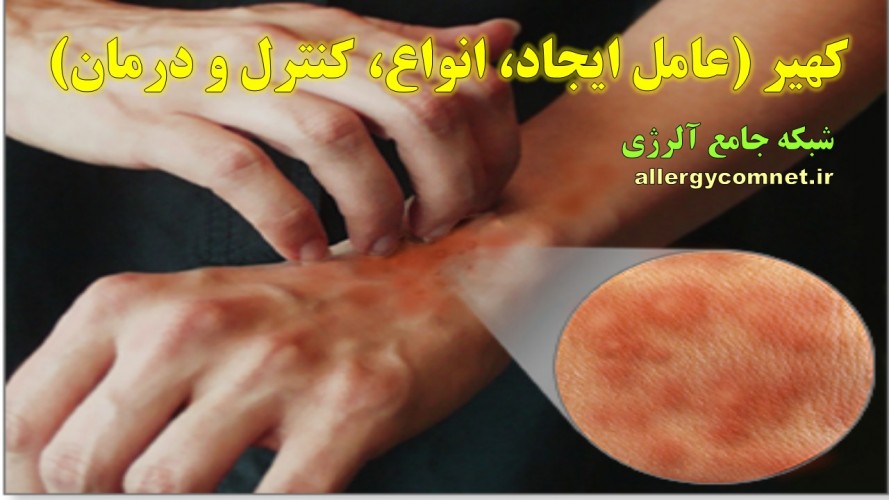 کهیر ، عامل ایجاد، انواع و کنترل و درمان- شبکه جامع آلرژی