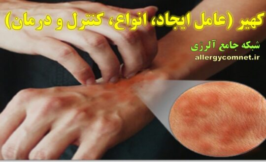 کهیر-،-عامل-ایجاد،-انواع-و-کنترل-و-درمان